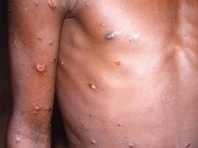 An image created during an investigation into an outbreak of monkeypox, which took place in the Democratic Republic of the Congo, 1996 to 1997, shows the arms and torso of a patient with skin lesions due to monkeypox, in this undated image obtained by Reuters on May 18, 2022.