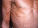 Ein Bild, das während einer Untersuchung eines Ausbruchs von Affenpocken, der 1996 bis 1997 in der Demokratischen Republik Kongo stattfand, erstellt wurde, zeigt die Arme und den Oberkörper eines Patienten mit Hautläsionen aufgrund von Affenpocken, in diesem undatierten Bild, das von Reuters erhalten wurde 18. Mai 2022.
