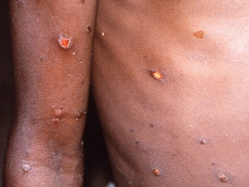 Britain offers smallpox shot as monkeypox cases spread in Europe