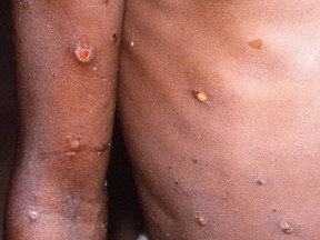 An image created during an investigation into an outbreak of monkeypox, which took place in the Democratic Republic of the Congo, from 1996 to 1997, shows the arms and torso of a patient with skin lesions due to monkeypox, in this undated image obtained by Reuters on May 18, 2022.