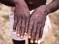 The hands of a patient with a rash due to monkeypox.
