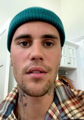 Justin Bieber has revealed he has Ramsay Hunt syndrome.