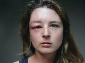 Young caucasian woman with a swollen eye from a wasp's sting. Allergy reaction on wasp bite.