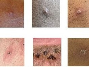 Pictures showing examples of rashes and lesions caused by the monkeypox virus are seen in this undated handout image obtained by Reuters on July 1, 2022.