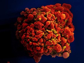 This handout photo made available by the U.S. National Institutes of Health shows a human white blood cell infected with the HIV virus.