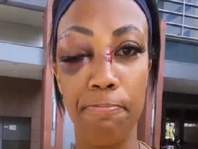 Screen shot of U.S. Olympian Kim Glass who suffered an attack by a homeless man. One of her eyes is swollen shut, her nose is bloodied.