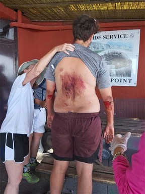 Verletzungen eines Mannes, der in den Krater des Vesuvs stürzte.  Führer Vulcanologiche Vesuvio