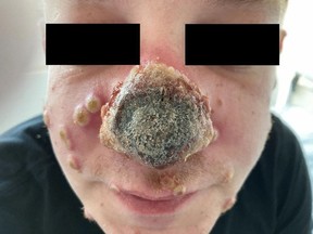 A man’s rotting nose following monkeypox diagnosis and severely undiagnosed STIs. (Boesecke, C., Monin, M.B., van Bremen, K., Schlabe, S., Hoffman, C./Infection)