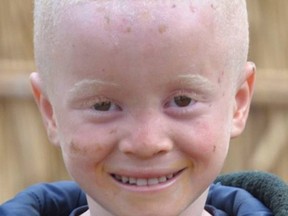 Albino hunters can make thousands of dollars killing the children whose body parts are used in witchcraft.
