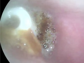 An English man thought he was going deaf because of issues he’d been having for five years. Turns out he had a piece of an earbud in his ears. Wallace Lee.