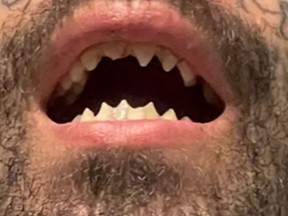 Accused sex sicko Michael Barajas has his teeth filed into points.