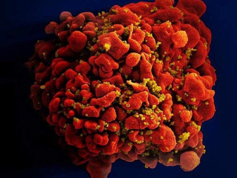 HIV patient cured after bone marrow transplant in rare case, research
