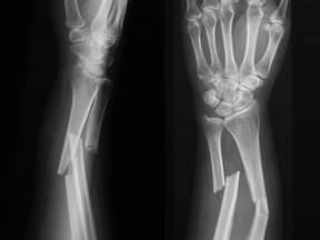 X-ray image of forearm, AP and lateral view, show fracture of ulna and radius. (Getty Images/iStockphoto)