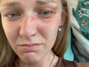 Lawyers for the family of murdered vlogger Gabby Petito released this photo on Tuesday showing her injuries following a domestic dispute. MOAB POLICE