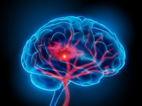 An illustration of human brain with stroke symptom.