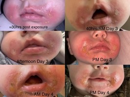 A B.C. mother is alerting others to the dangers of "margarita burn" which left blisters on her baby daughter's face.