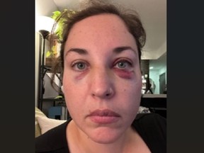 Nicky Lightstone, 36, was attacked by Lionel Williams, 36, while walking her dog in regent Park in January 2023 and has since learned the homeless man assaulted two other women in the preceding two months.