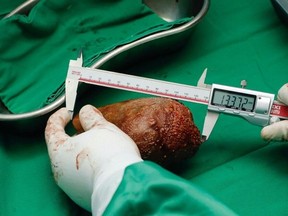The largest kidney stone in history has been removed from a patient in Sri Lanka, according to CNN.