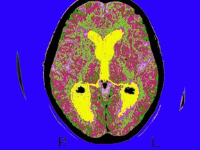 Skan mózgu pacjenta dotkniętego chorobą Alzheimera.