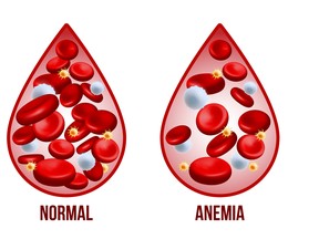 Iron deficiency anemia.
