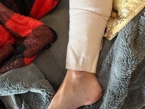 An attacking dog stripped Cara‘s calf of flesh, exposing the muscle below. (Jack Boland, Toronto Sun)
