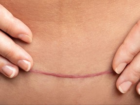 Closeup of a healed scar after C-Section surgery on a female belly.