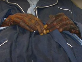The hands of Stoneman Willie, who will be finally buried 128 years later after he was embalmed at a Philadelphia funeral home in 1895.
