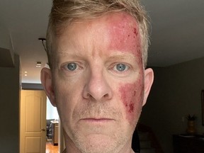Selfie of Sportsnet’s Jamie Campbell as he takes leave to deal with ’pre-skin cancer’