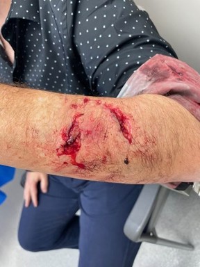 Le pilote d'Air Canada Connor Dubuc, 54 ans, a eu besoin de 14 points de suture pour refermer ses blessures à l'avant-bras gauche et à la paume après avoir été attaqué par un chien à Etobicoke le mardi 7 novembre 2023.
