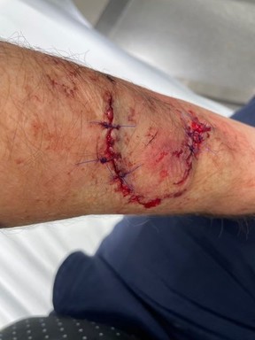 Le pilote d'Air Canada Connor Dubuc, 54 ans, a eu besoin de 14 points de suture pour refermer ses blessures à l'avant-bras gauche et à la paume après avoir été attaqué par un chien à Etobicoke le mardi 7 novembre 2023.