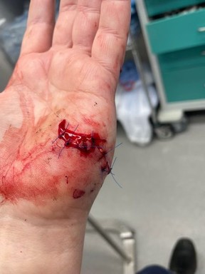 Le pilote d'Air Canada Connor Dubuc, 54 ans, a eu besoin de 14 points de suture pour refermer ses blessures à l'avant-bras gauche et à la paume après avoir été attaqué par un chien à Etobicoke le mardi 7 novembre 2023.
