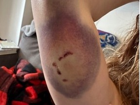 Cara was attacked July 30, 2023 by a vicious dog. Pictured on Aug. 2, she displays one of her many injuries. (Jack Boland, Toronto Sun)