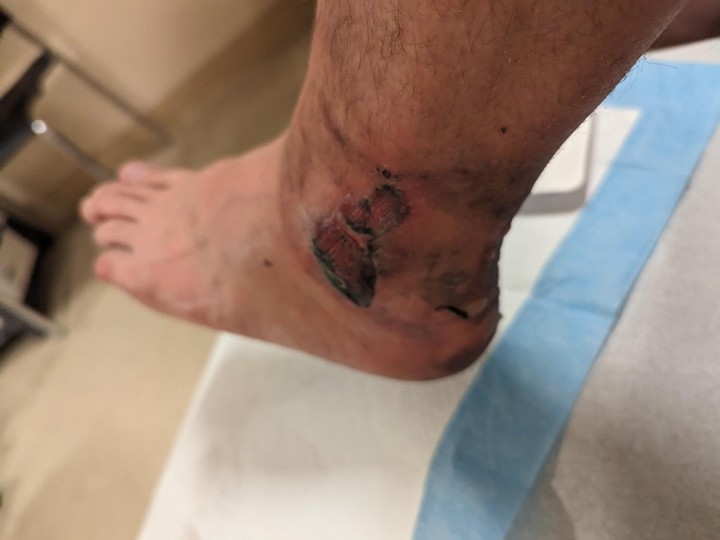  The better side of burned ankle of Shayne Lemieux, whose battery heated insole caught fire.