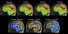 This series of PET brain scan images provided by Mount Sinai in 2024 shows changes in patient Emily Hollenbeck with deep brain stimulation therapy. Analyzing the brain activity of DBS patients, researchers found a unique pattern that reflects the recovery process.