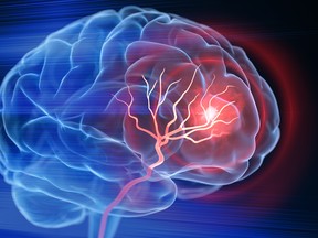 Having a stroke could significantly increase the risk of developing dementia, particularly over the first year but for as long as 20 years after the stroke, new research suggests.