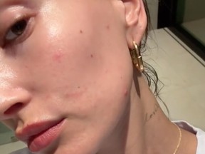 Hailey Bieber shared to social media her skin flare-up this week.