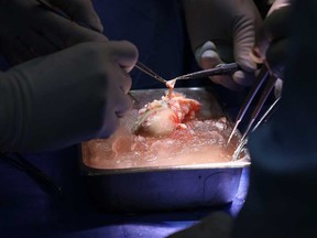 In this March 16, 2024, image courtesy of the Massachusetts General Hospital in Boston, Massachusetts, surgeons prepare the pig kidney for transplantation during the world's first genetically modified pig kidney transplant into a living human.