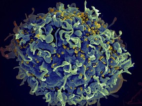 FILE - This electron microscope image made available by the U.S. National Institutes of Health shows a human T cell, in blue, under attack by HIV, in yellow, the virus that causes AIDS. Three women who were diagnosed with HIV after getting "vampire facial" procedures at an unlicensed New Mexico medical spa are the first believed to have contracted the virus through a cosmetic procedure using needles, according to federal health officials.