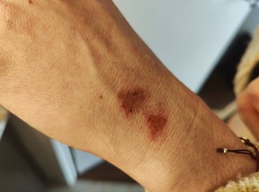 Andrea Balmaceda says she was attacked by a stranger downtown and received bruises on her face along the jawline, a cut on her left wrist from a fall and a goose egg lump on her hip. She also says she sprained her right wrist during the fall. SUPPLIED PHOTO
