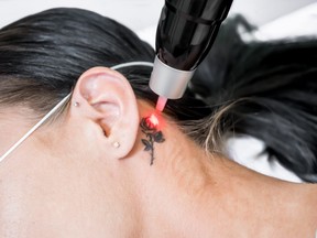 Laser tattoo removal treatment session on patient, using picosecond technology, to break down tattoo ink into smaller particles.