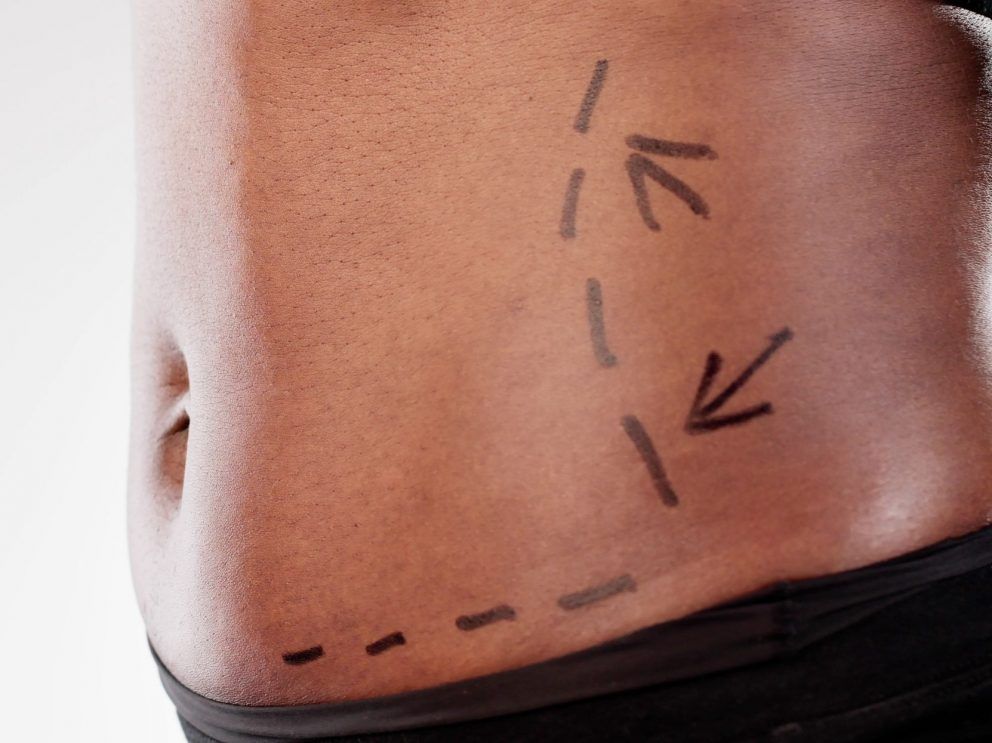 A British woman died during cosmetic surgery in Turkey earlier this year.