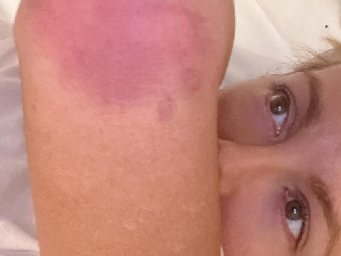 Bruised Beckinsale looks like she's been 'through the wars' after filming movie