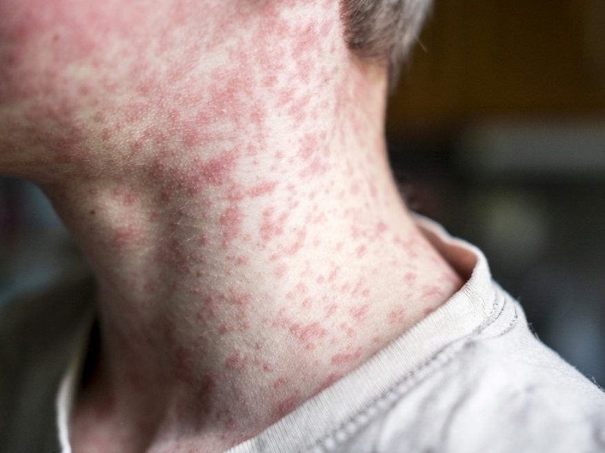 Toronto Public Health warns of potential measles exposure in west end