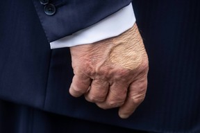 U.S. President Donald Trump's right hand is bruised due to shaking hands and taking aspirin, the White House says