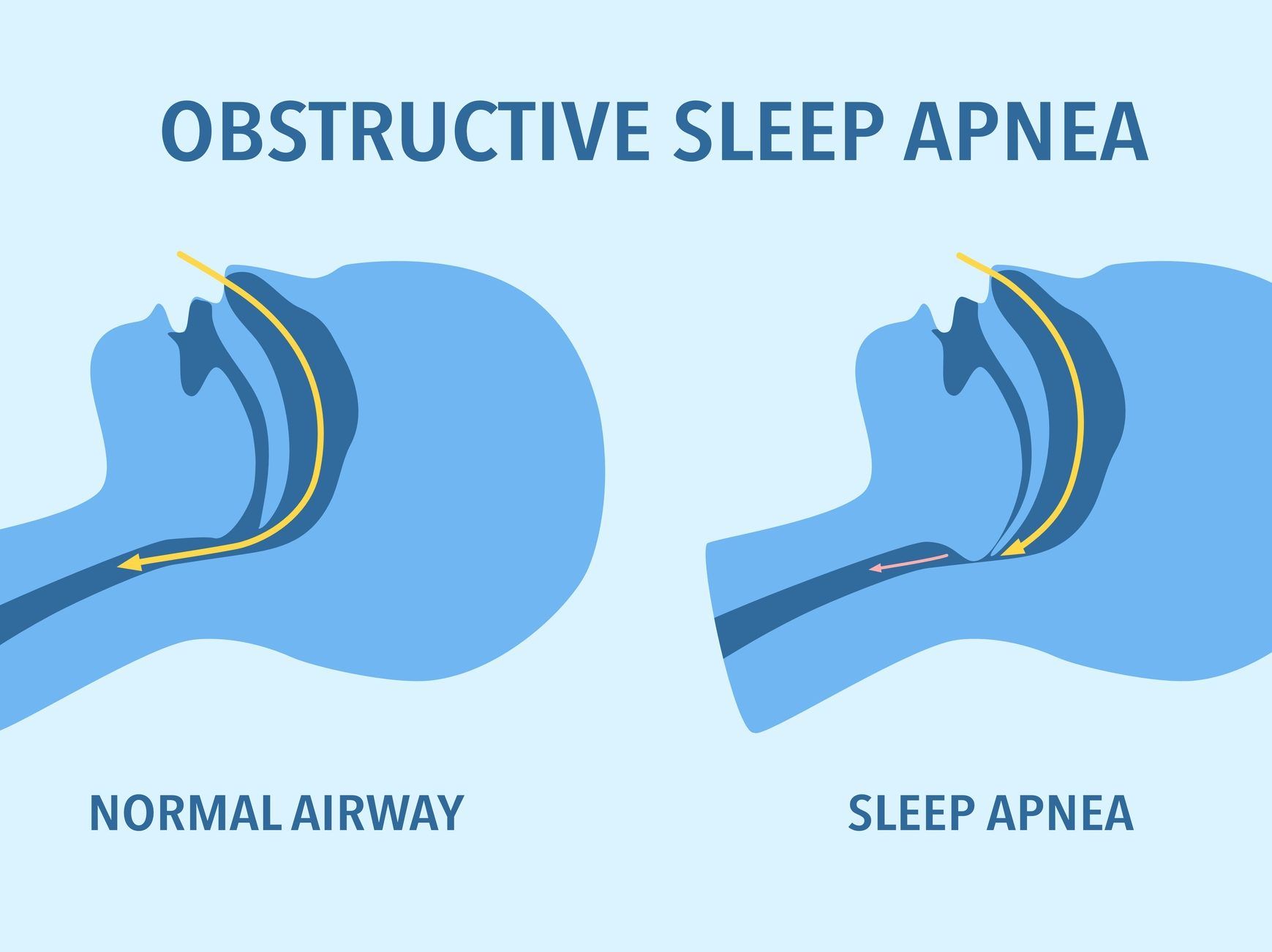 Obstructive sleep apnea linked to Parkinson’s disease: Study
