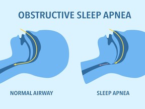 Obstructive sleep apnea