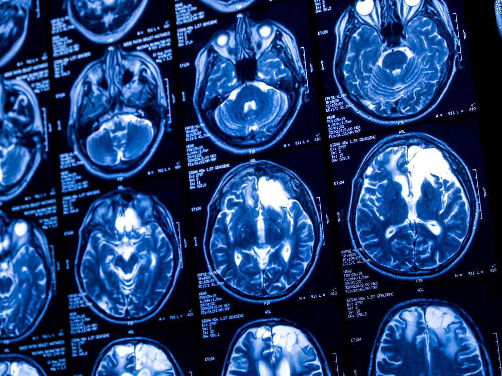 Close-up of CT scan with brain. Medicine, science and education MRI brain background. Magnetic resonance imaging. Tomography shot
