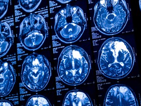 Close-up of CT scan with brain. Medicine, science and education MRI brain background. Magnetic resonance imaging. Tomography shot