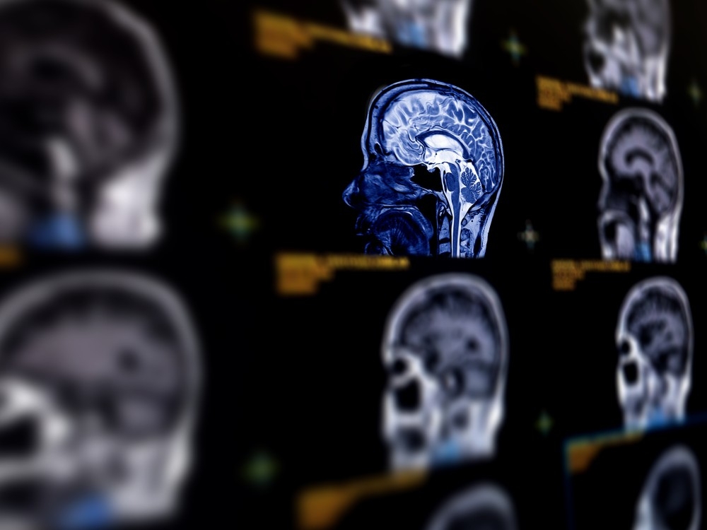 STROKE BREAKTHROUGH: Lifesaving Heart Drug Now Approved!