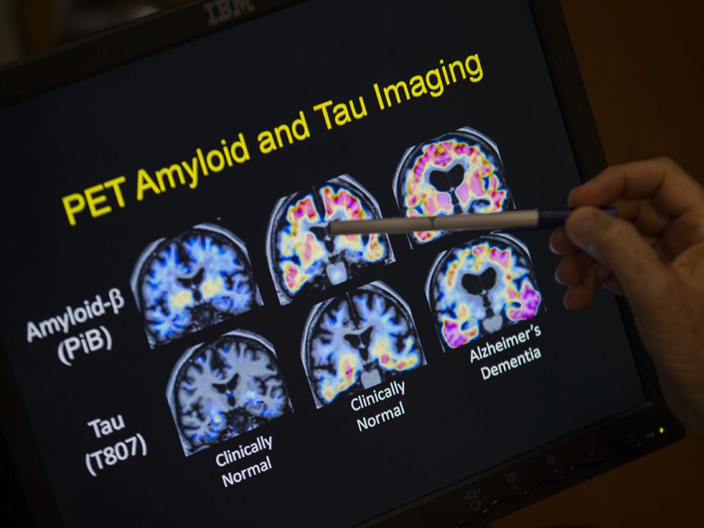 JAY GOLDBERG: Bureaucracy slowing Canadians’ access to breakthrough Alzheimer’s drug 
